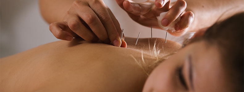 Woman receiving acupuncture